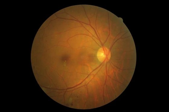 PPDR(增生前糖尿病視網膜病變)